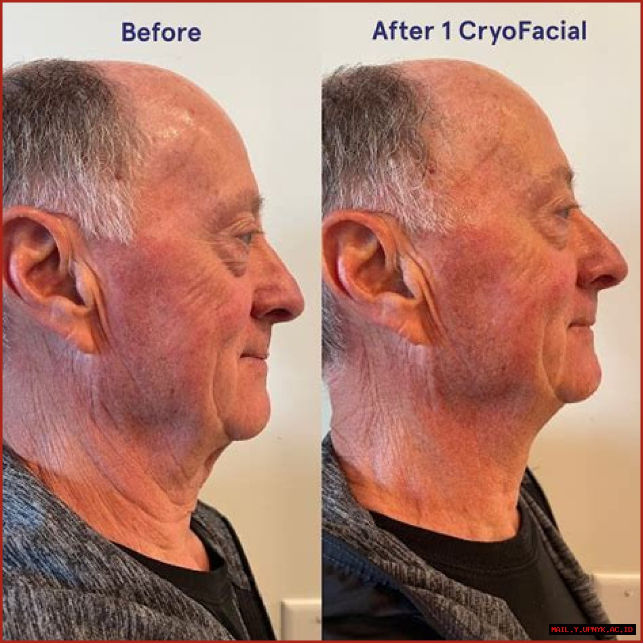 Before And After Cryotherapy Pictures: See The Transformation