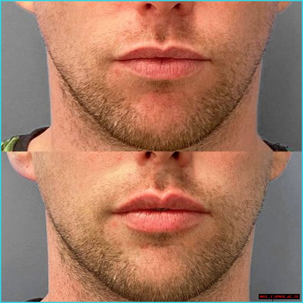 Remarkable Lip Enhancement: Explore Men's Lip Fillers Before And After