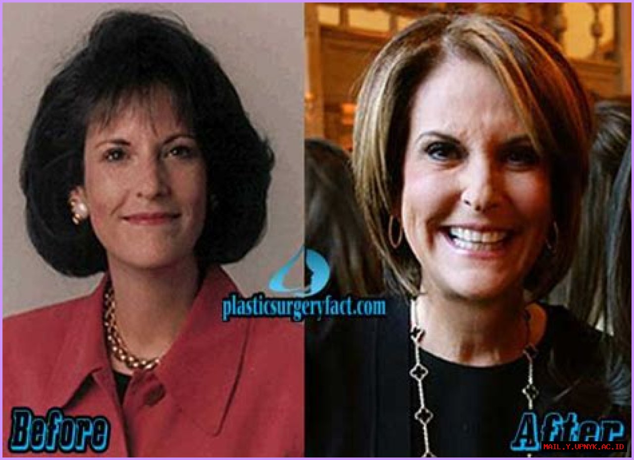 Ultimate Guide: Unveiling Gloria Borger's Plastic Surgery Journey